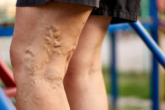 Acupuncture for Varicose Veins Treatment